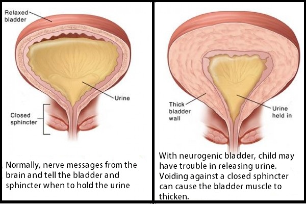 Neurogenic-Bladder-600x400